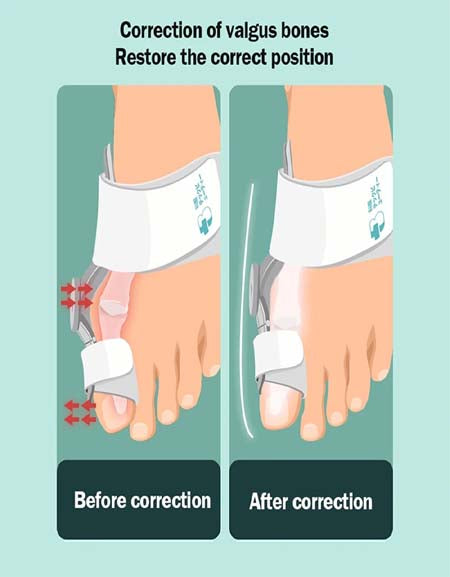 Foot Bone Thumb Adjuster Correction Pedicure Brace Zydropshipping